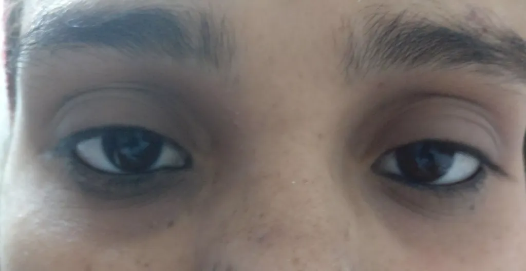 Dark Circle Removal Treatment in Gurugram