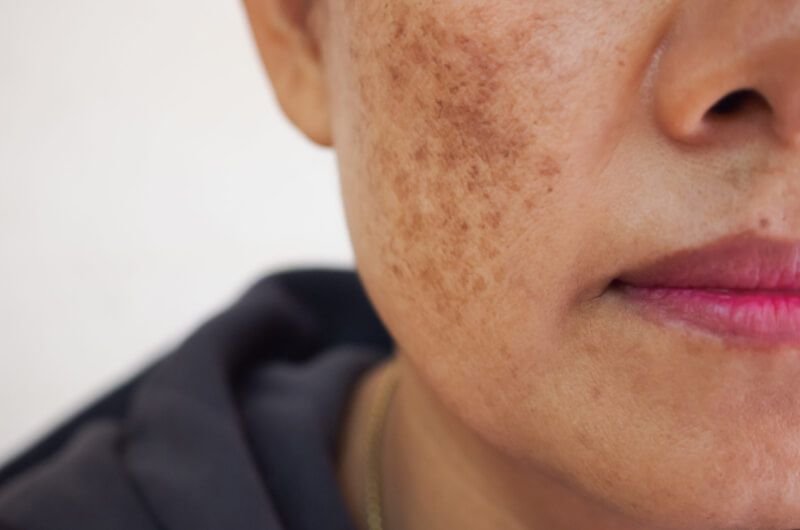 Pigmentation Treatment and Melasma in Gurugram