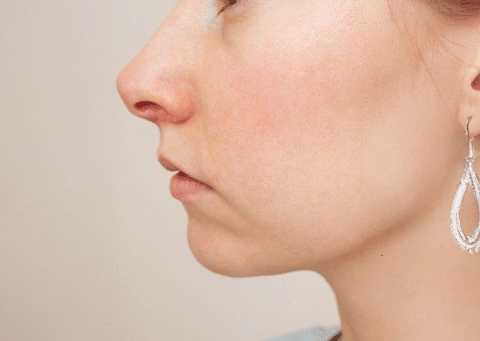 Advanced Sensitive Skin Treatment & Rosacea Care in Gurugram