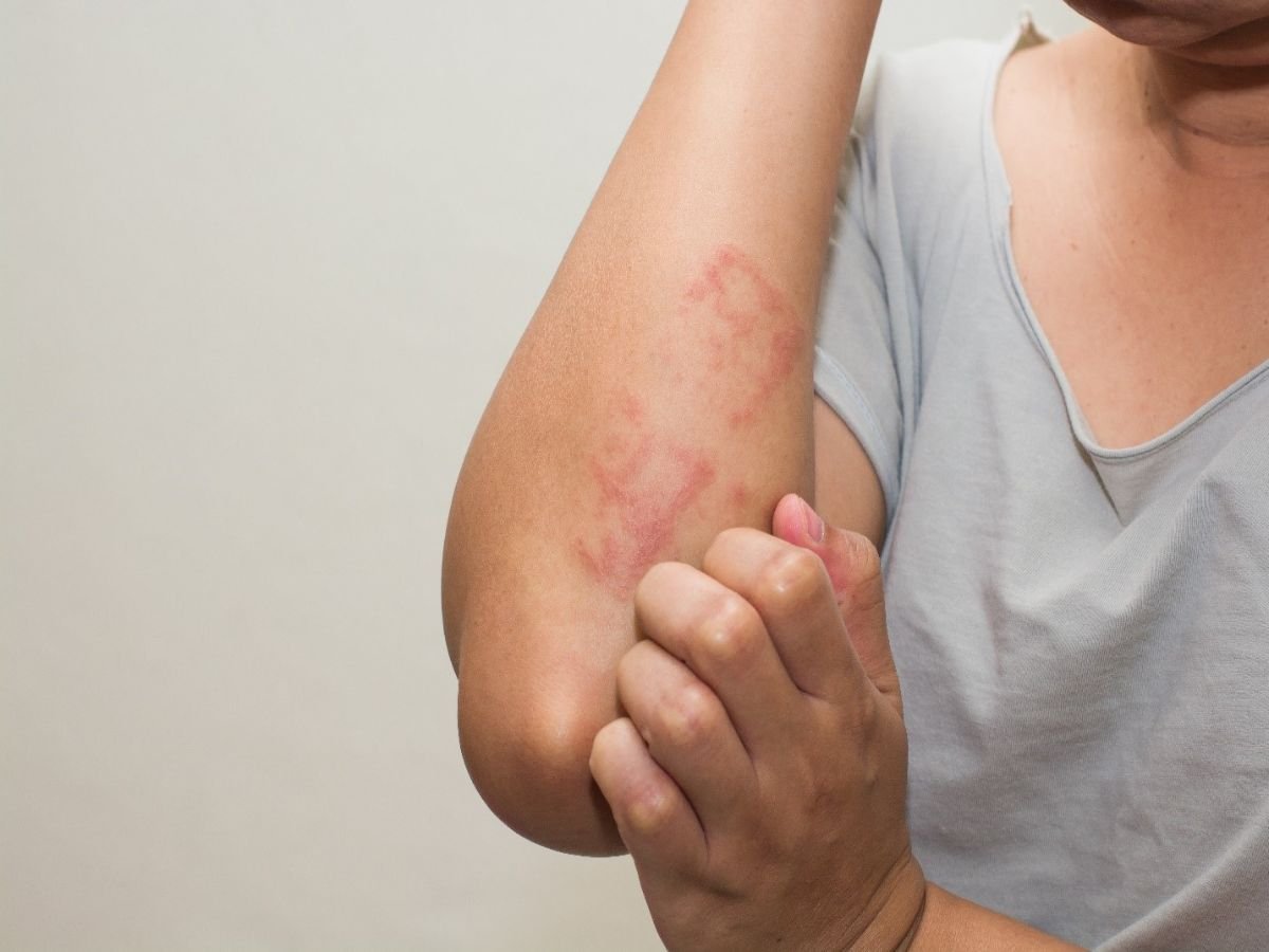 Skin Allergy Treatment & Consultation in Gurugram