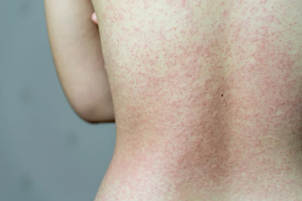 Skin Allergy Treatment for Adults, Children, and Sensitive Skin Patients
