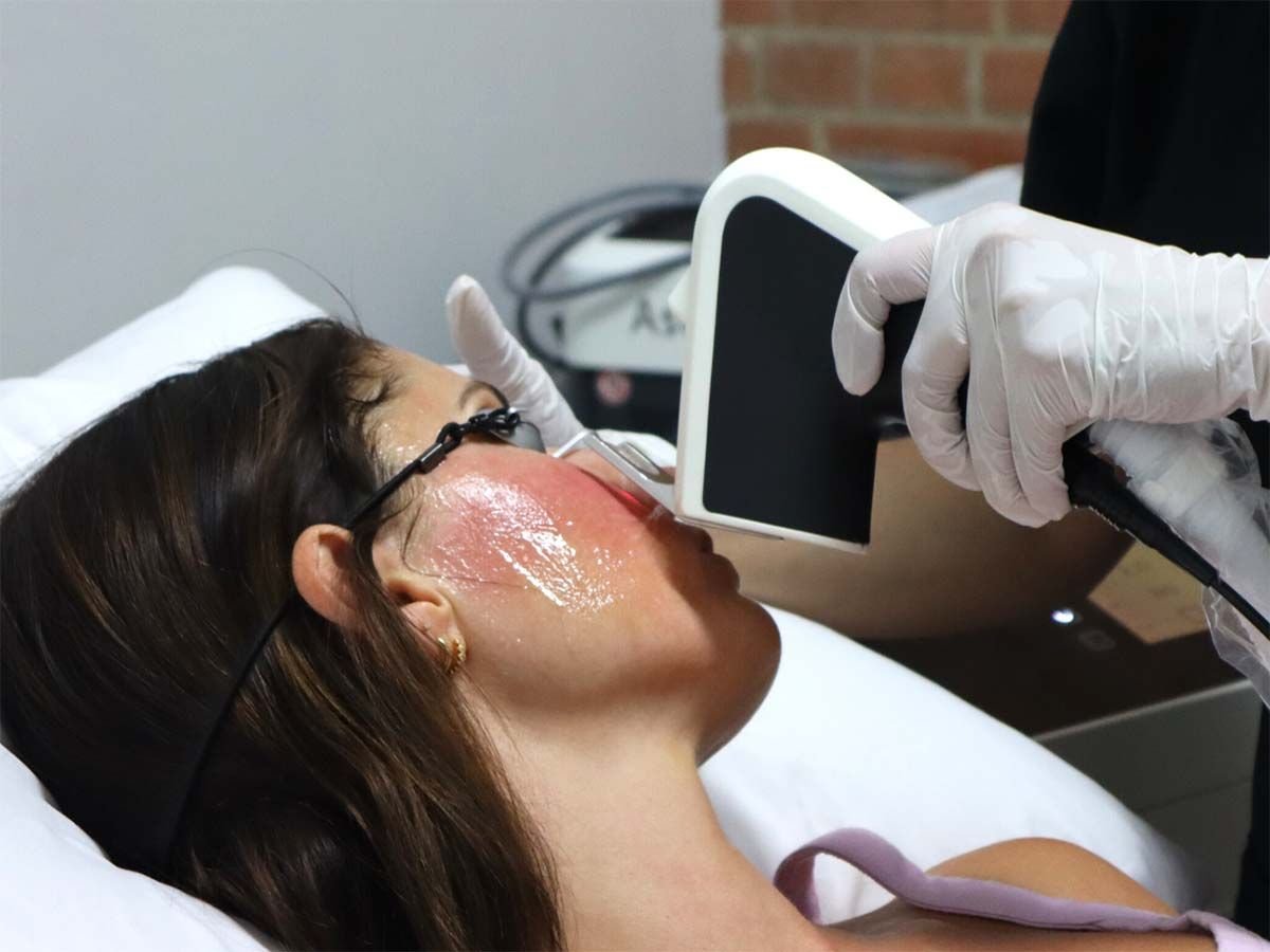 Types of Laser Skin Resurfacing Treatments Available at Wellness Story
