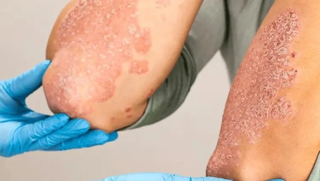 Why Patients Choose Wellness Story for Skin Allergy Treatment in Gurugram
