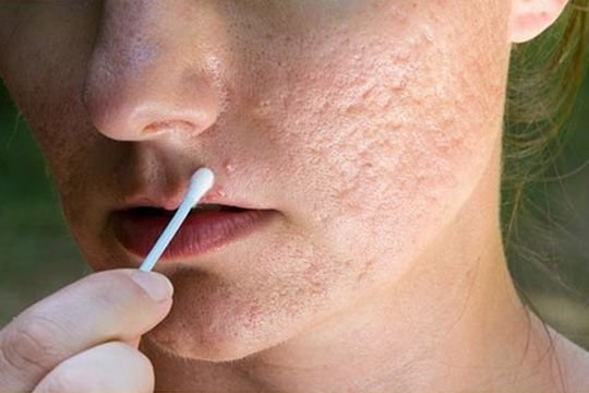Acne Scar Removal Laser Treatment in Gurugram