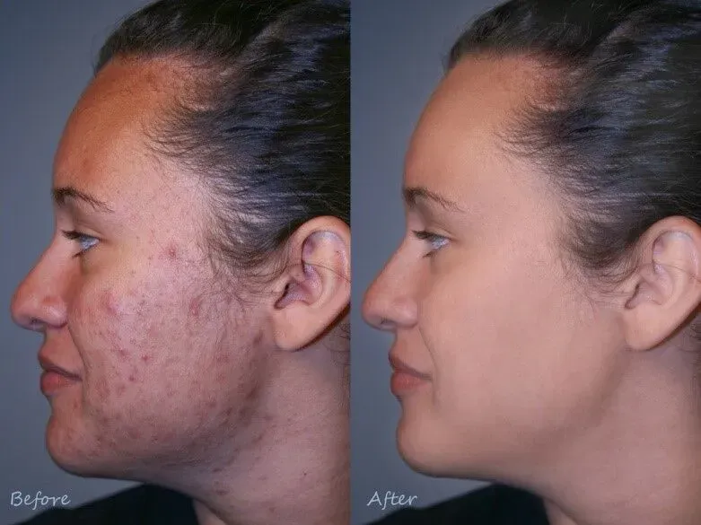 Acne Scar Removal Treatment
