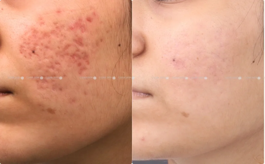 Acne Scars Need Professional Treatment
