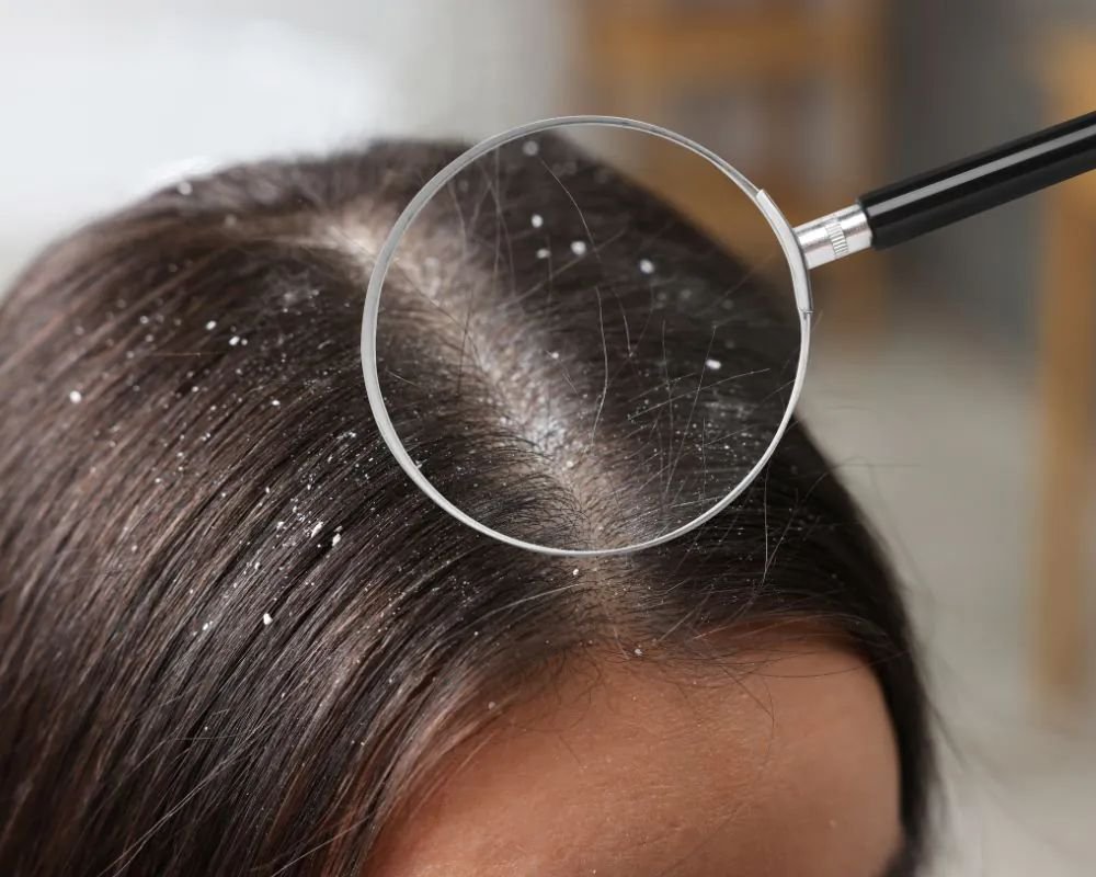 Advanced Dandruff Treatment in Gurugram for Long-Term Relief
