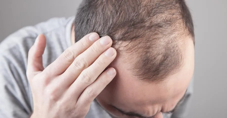 Hair Loss in Gurugram