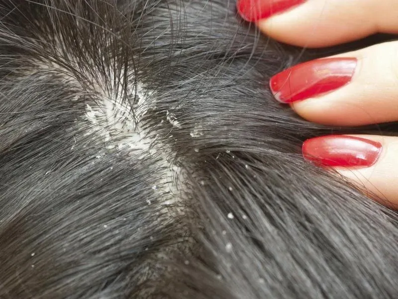 Home Remedies & Shampoos