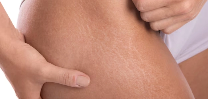 Stretch Marks Removal in Gurugram