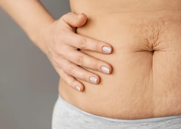 Tired of hiding your stretch marks and wondering if anything will actually work?