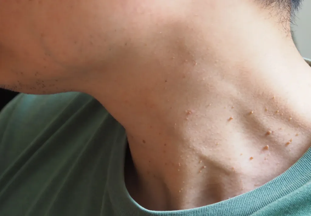 How We Remove Skin Tags