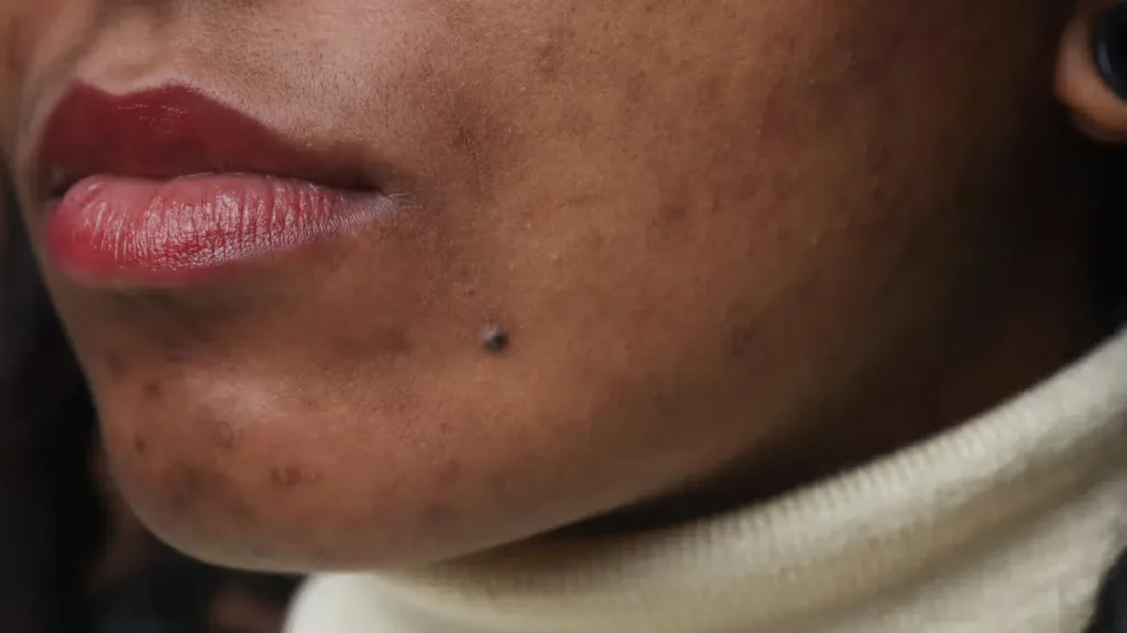 Is a Mole on Your Face Bothering You?