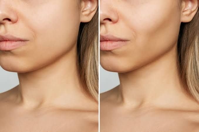 Non-Surgical Facial Sculpting