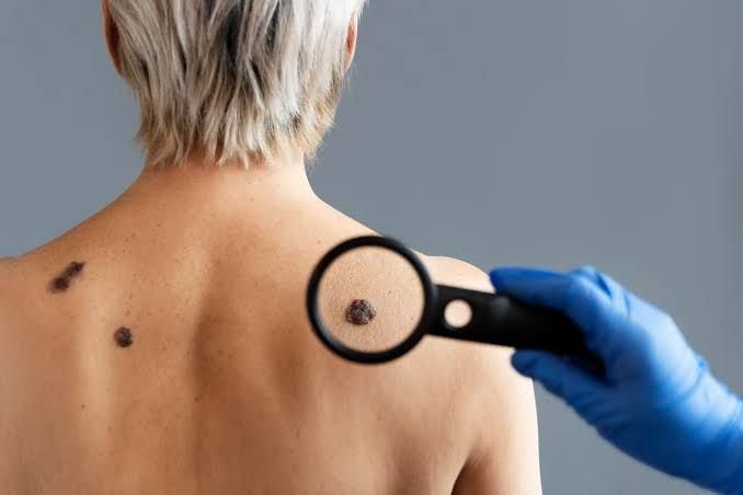 Professional Skin Tag Removal in Gurgaon for Safe, Personalised Care 