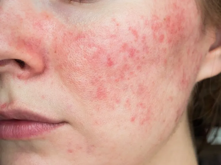 Story for Skin Radiance Treatment in Gurugram